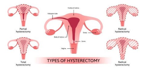 Is life normal after a hysterectomy