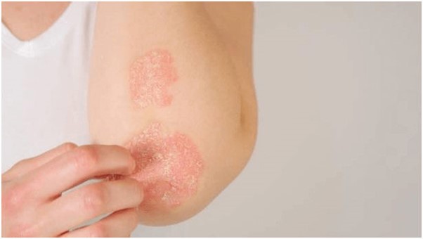 Psoriasis