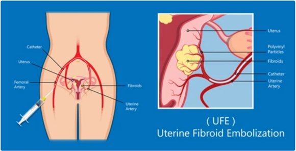 UFE Procedure 