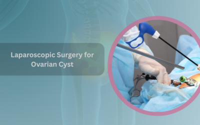 Laparoscopic Surgery for Ovarian Cyst