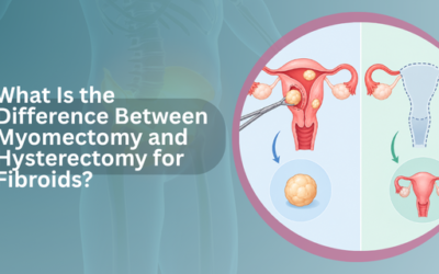 What Is the Difference Between Myomectomy and Hysterectomy for Fibroids?